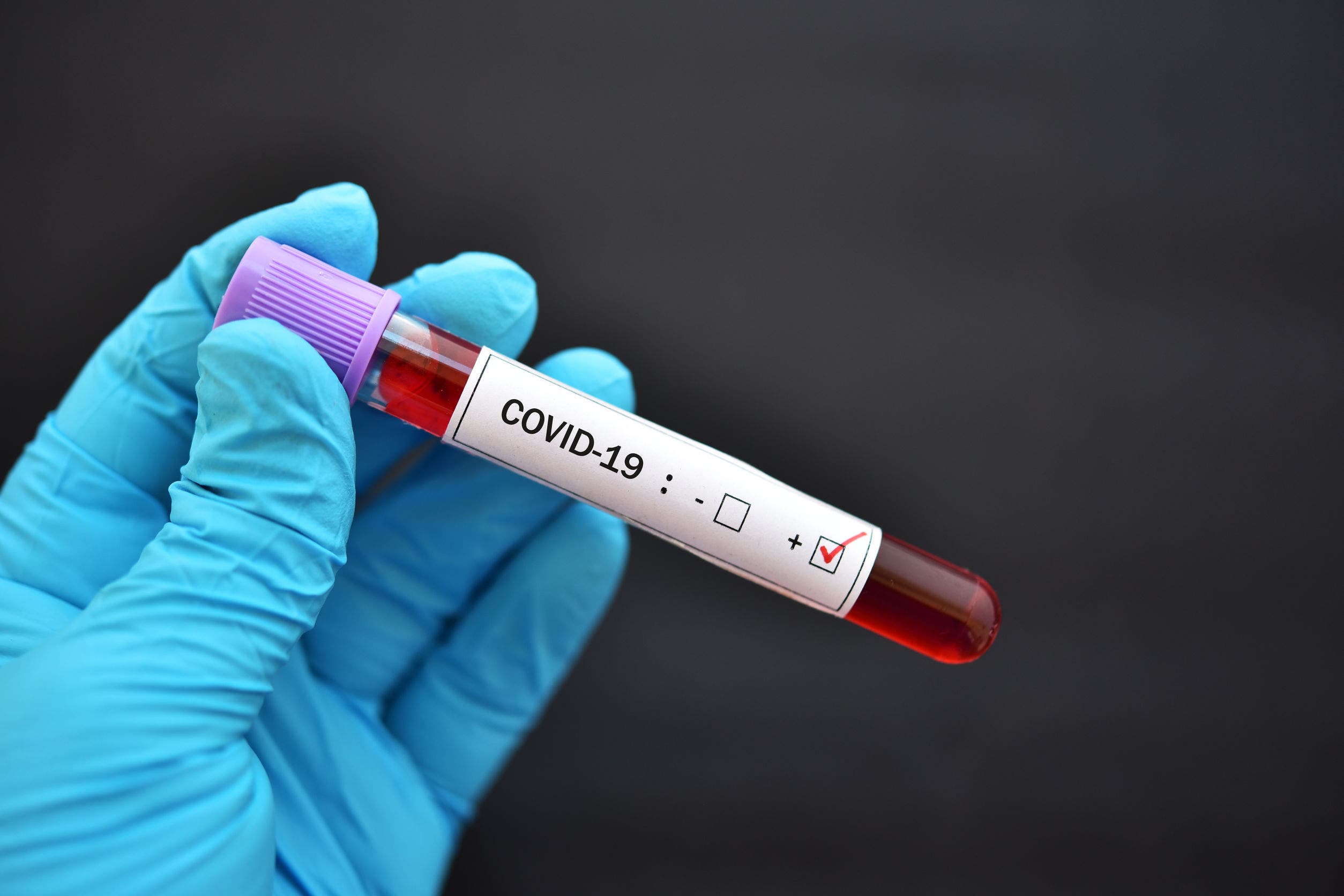 ÜST dünyada koronavirusa yoluxanların sayını açıqladı
