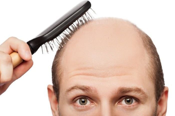 Niyə kişilərin saçı daha çox TÖKÜLÜR? – MARAQLI SƏBƏB