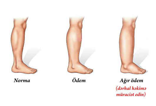 Ayaqlarınız tez-tez şişirsə, MÜTLƏQ OXUYUN: 5 təhlükəli səbəb Ayaqlarınız tez-tez şişirsə, MÜTLƏQ OXUYUN: 5 təhlükəli səbəb