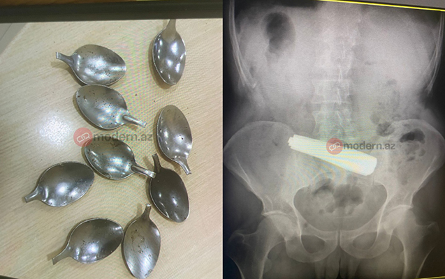Bakı sakini 9 ədəd qaşıq uddu – FOTO