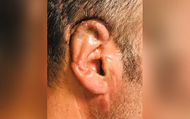 Qopan qulağı 34 saat sonra yerinə tikildi - FOTO Qopan qulağı 34 saat sonra yerinə tikildi - FOTO