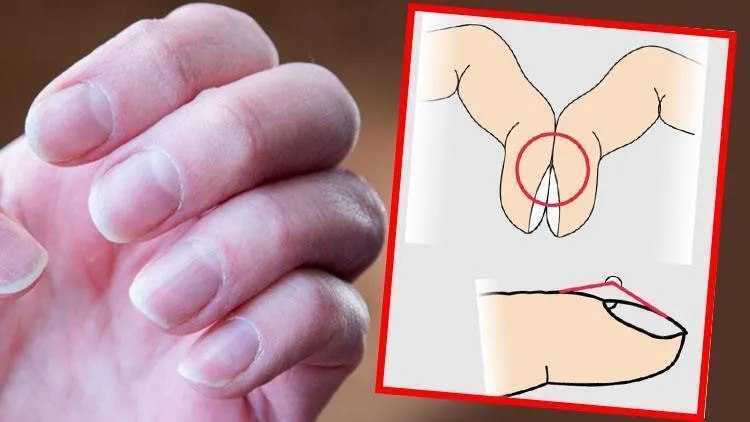 Ölümcül xəstəliyin gizli əlaməti: Barmaqlardakı bu dəyişiklik sizə XƏBƏRDARLIQ EDİR Ölümcül xəstəliyin gizli əlaməti: Barmaqlardakı bu dəyişiklik sizə XƏBƏRDARLIQ EDİR