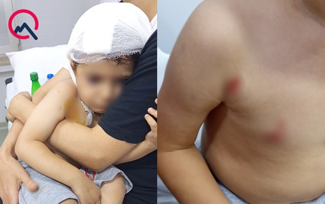 Masazırda 2 yaşlı uşağı it dişlədi – FOTO