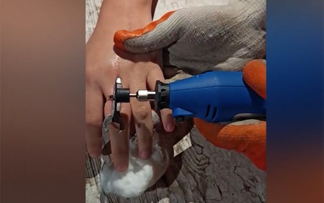 Qızın barmağında qalan üzüyü belə çıxardılar – VİDEO Qızın barmağında qalan üzüyü belə çıxardılar – VİDEO