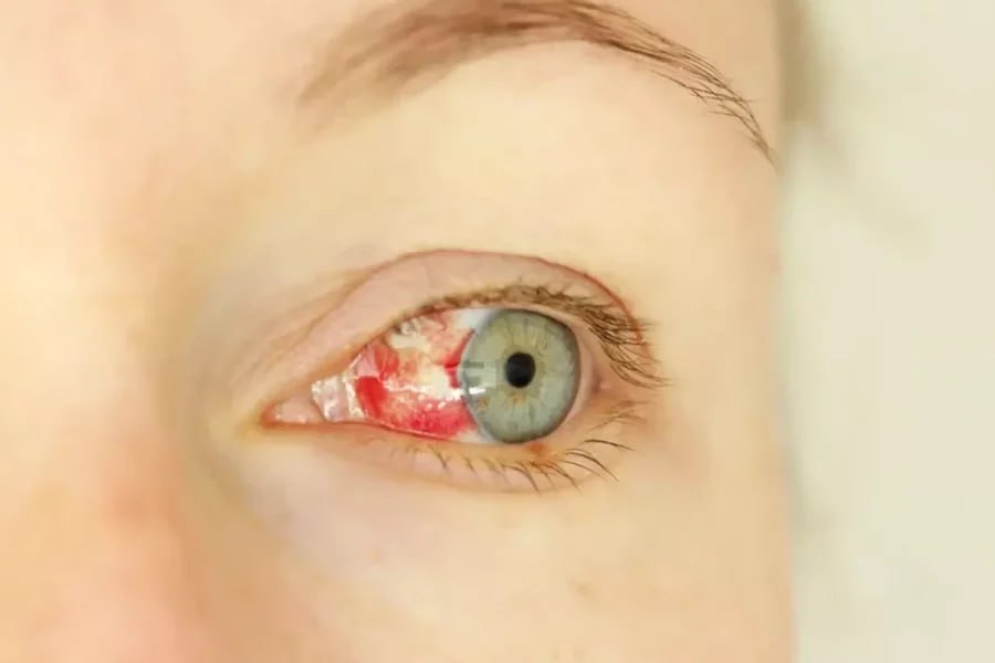 Göz qanaması ilə başlayan gizli virus yayılır