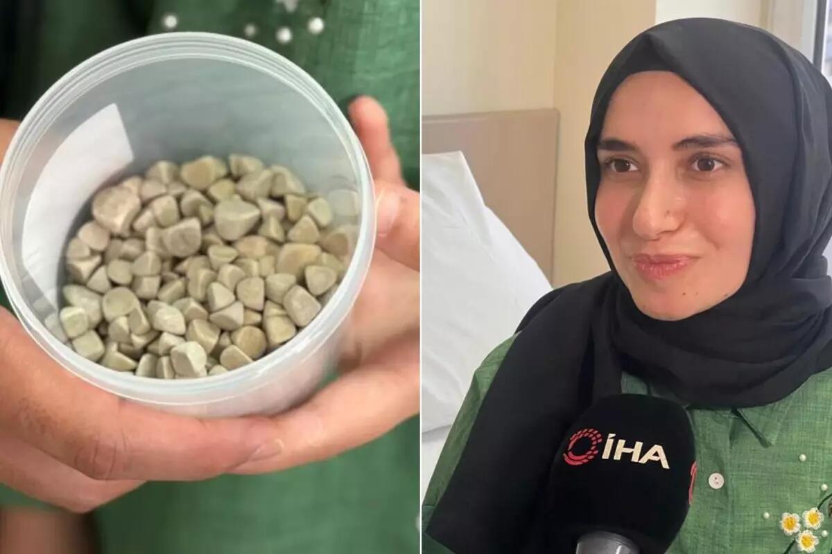 21 yaşlı Fatmanın bədənindən 287 daş çıxarıldı – FOTO