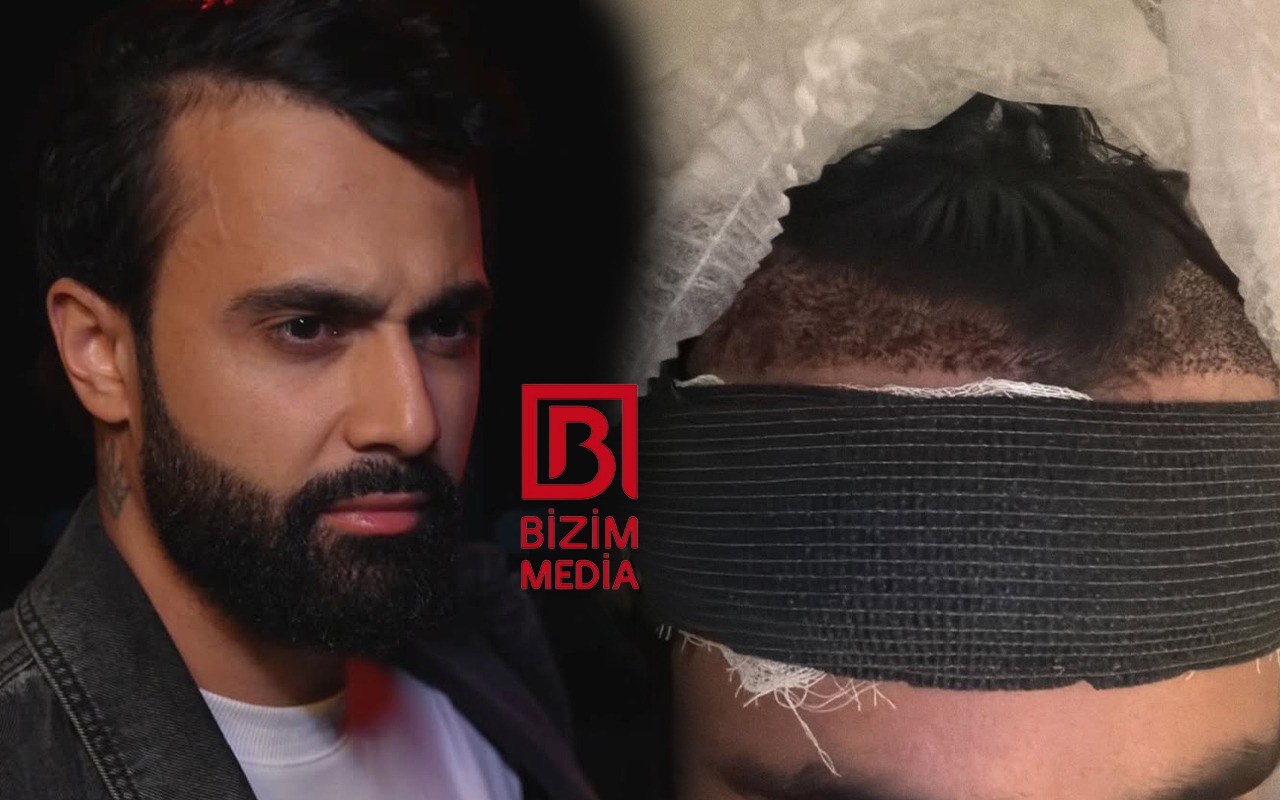 Hüseyn Həsənov saç əkdirdi - FOTO Hüseyn Həsənov saç əkdirdi - FOTO