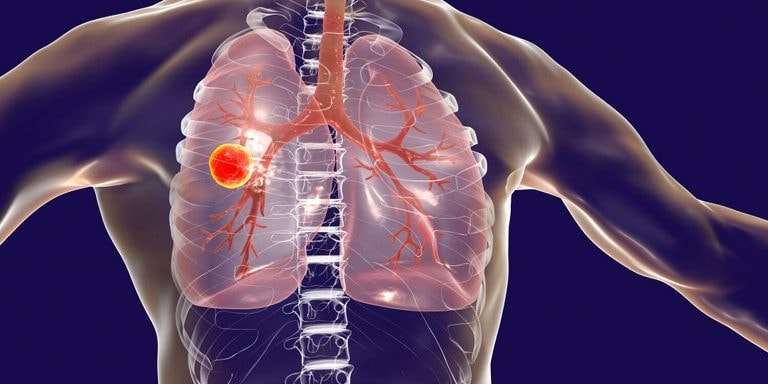 Azərbaycanda vərəmə yoluxanların sayı AZALIB – RƏSMİ