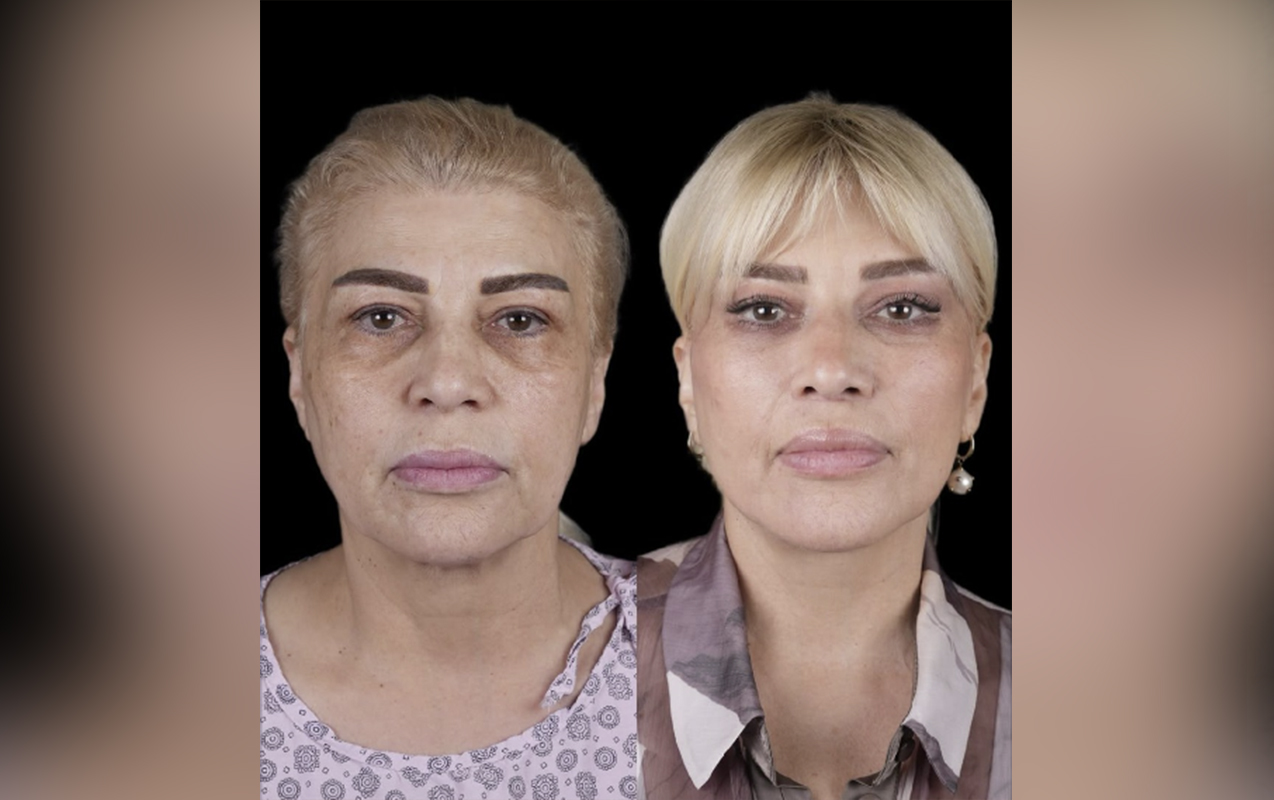 Mətanət İsgəndərli əməliyyatla belə dəyişdi – FOTO