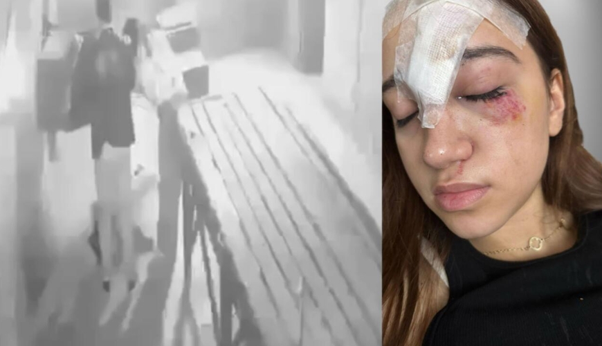 Bakıda qorxu evinə gedən 15 yaşlı qız xəsarət aldı - Alnına 11 tikiş qoyuldu