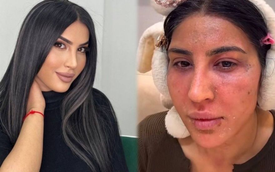 Reklam etdiyi pilinq Ləmanın üzünü yandırdı