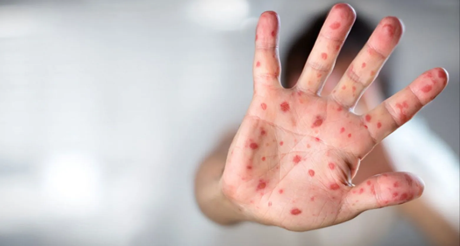 Rusiyada meymunçiçəyinə yeni yoluxma qeydə alınıb