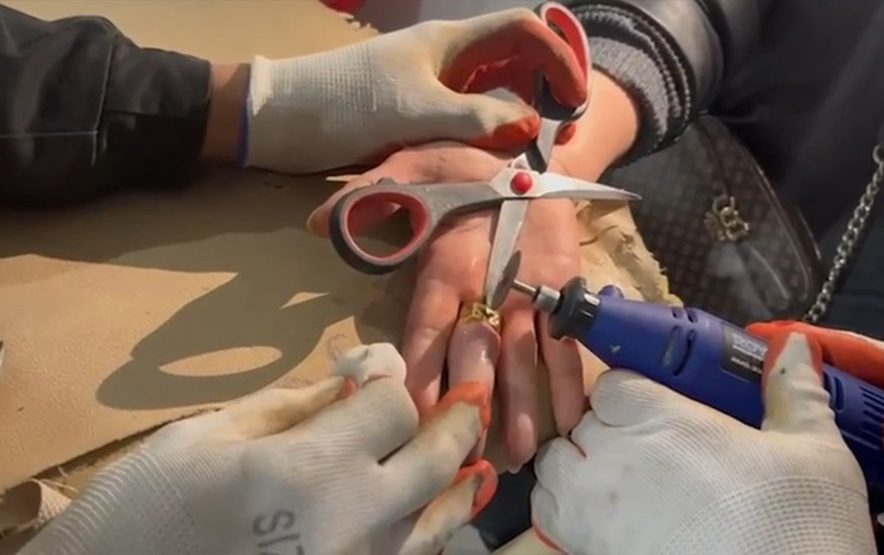 Barmağında sıxışan üzüyü belə çıxardılar &ndash; VİDEO