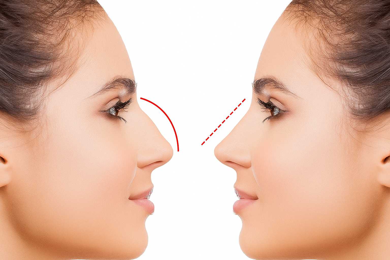 Azərbaycanda bu şəxslərə burun əməliyyatı pulsuz oldu