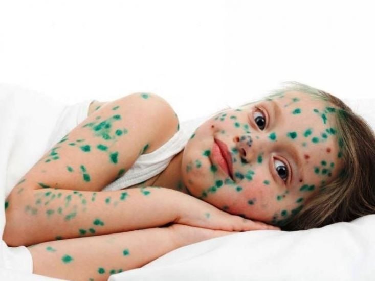 Su çiçəyi yenidən yayılır – Pediatrdan xəbərdarlıq Su çiçəyi yenidən yayılır – Pediatrdan xəbərdarlıq