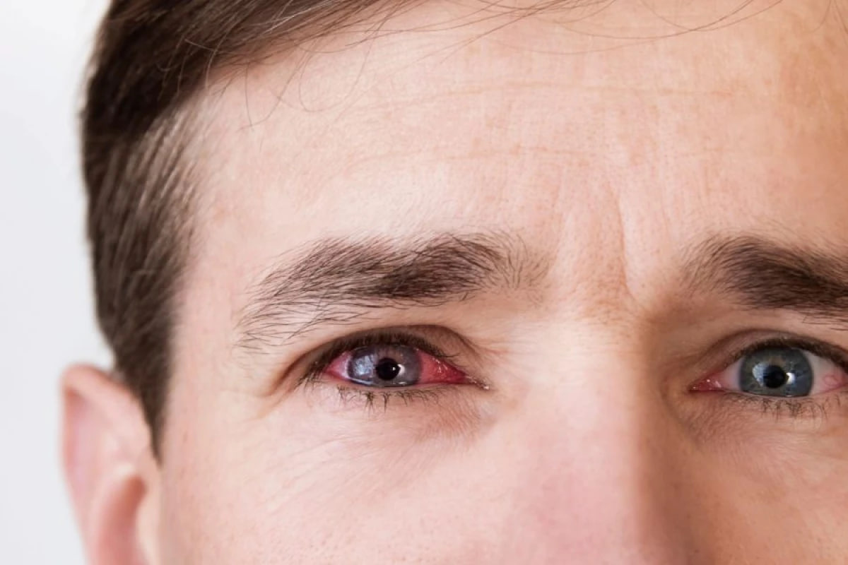 Kişinin gözündən metal parçası çıxarıldı &ndash; FOTO