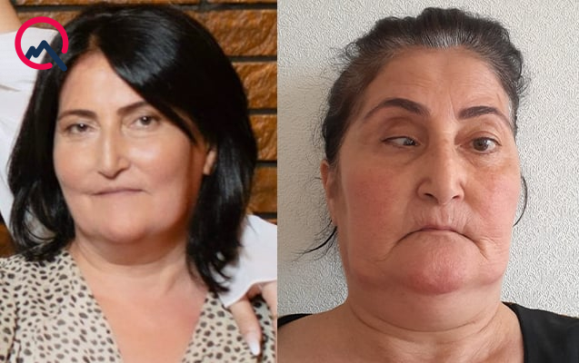 Bu klinika təzminat ödəyəcək - Burun düzəldəndə gözü zədələyib &ndash; FOTO