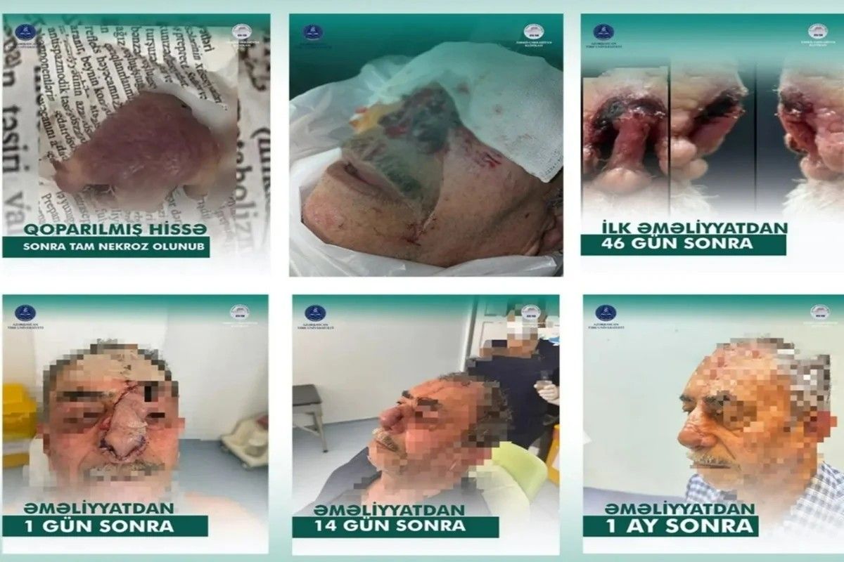 İt dişləməsi nəticəsində burnunu itirən xəstəyə yeni burun formalaşdırıldı - Azərbaycanda unikal əməliyyat – FOTO/VİDEO İt dişləməsi nəticəsində burnunu itirən xəstəyə yeni burun formalaşdırıldı - Azərbaycanda unikal əməliyyat – FOTO/VİDEO