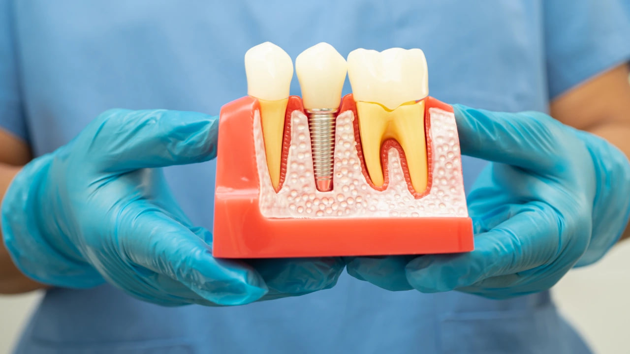 Ölü heyvan və insan sümüyündən hazırlanan diş implantları – Yeni sahibinin şəxsiyyətini dəyişə bilərmi? Ölü heyvan və insan sümüyündən hazırlanan diş implantları – Yeni sahibinin şəxsiyyətini dəyişə bilərmi?