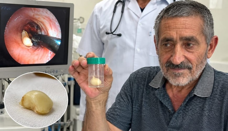 6 ay ağciyərində bu bitki ilə yaşadı – həqiqət xəstəxanada üzə çıxdı 6 ay ağciyərində bu bitki ilə yaşadı – həqiqət xəstəxanada üzə çıxdı