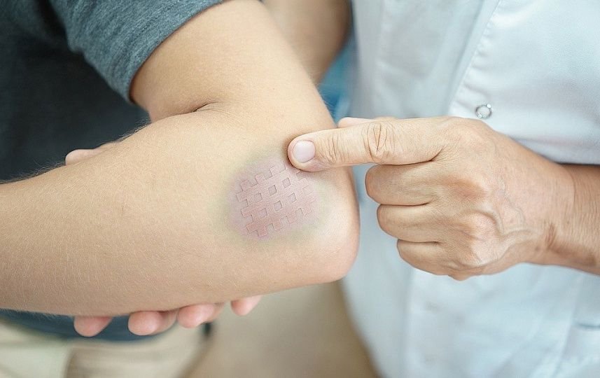 C vitamini çatışmazlığının əlamətləri – Diş əti qanayır