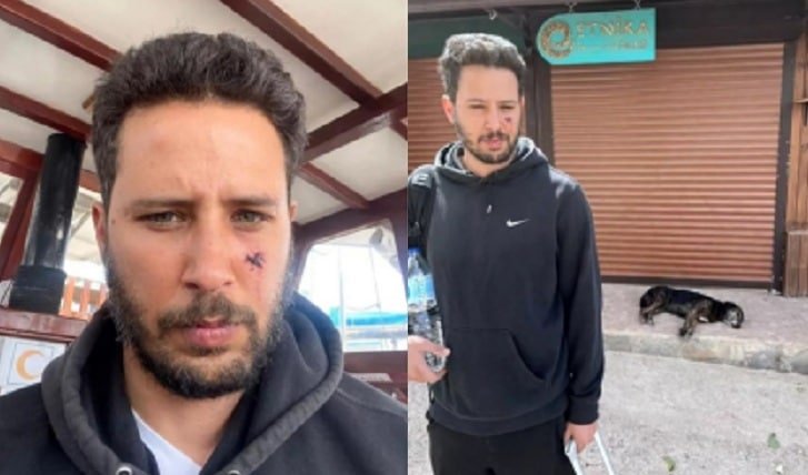 Tanınmış aktyorun üzünü it dişlədi, bu hala düşdü... - FOTO