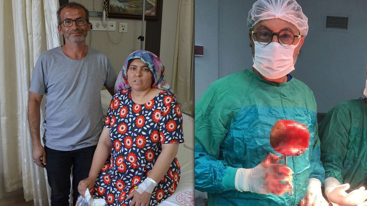 Xəstəxanaya gedən qadın ŞOK keçirdi &ndash; Qarnından 1 kq ağırlığında DAŞ çıxarıldı