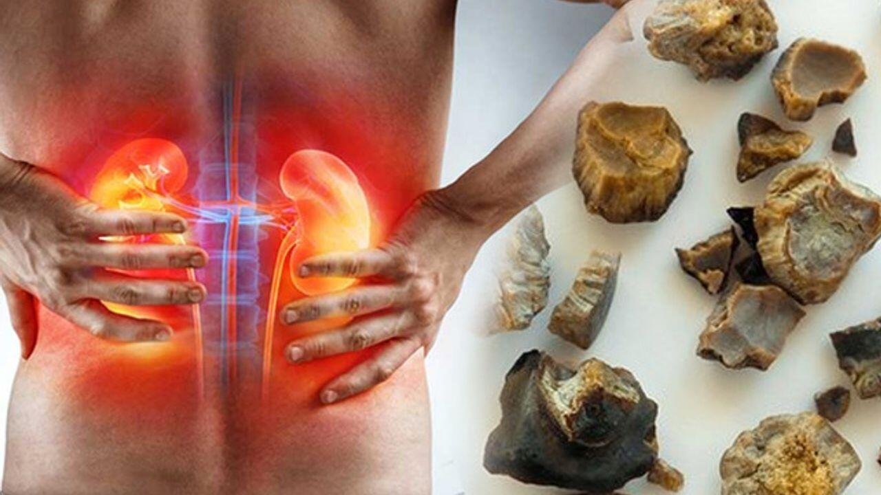 Alimlər böyrək daşlarına yeni çarə TAPDI - FOTO Alimlər böyrək daşlarına yeni çarə TAPDI - FOTO
