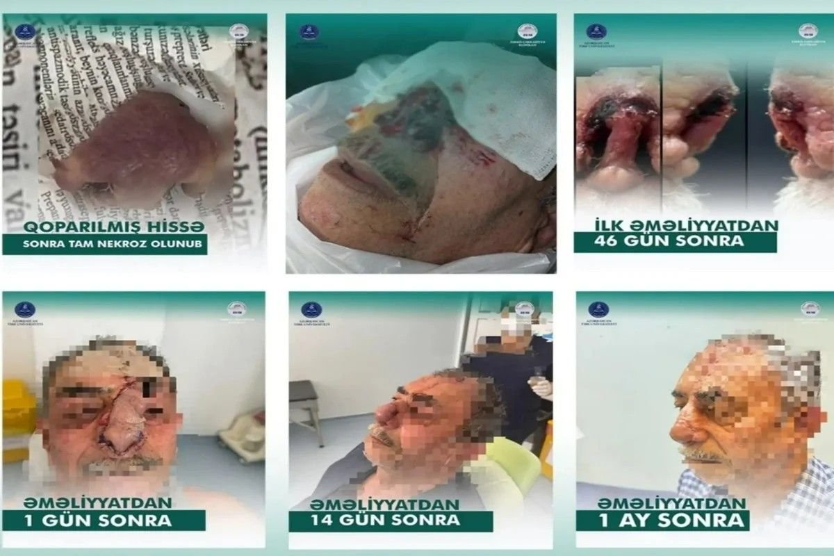 İt dişləməsi nəticəsində burnunu itirən xəstəyə yeni burun formalaşdırıldı - Azərbaycanda unikal əməliyyat &ndash; FOTO/VİDEO