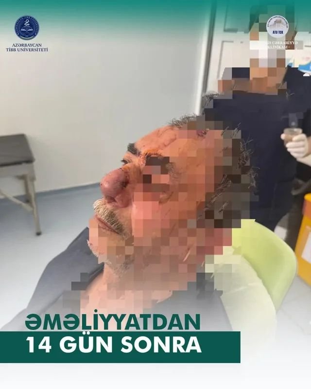 İt dişləməsi nəticəsində burnunu itirən xəstəyə yeni burun formalaşdırıldı - Azərbaycanda unikal əməliyyat – FOTO/VİDEO - foto 3