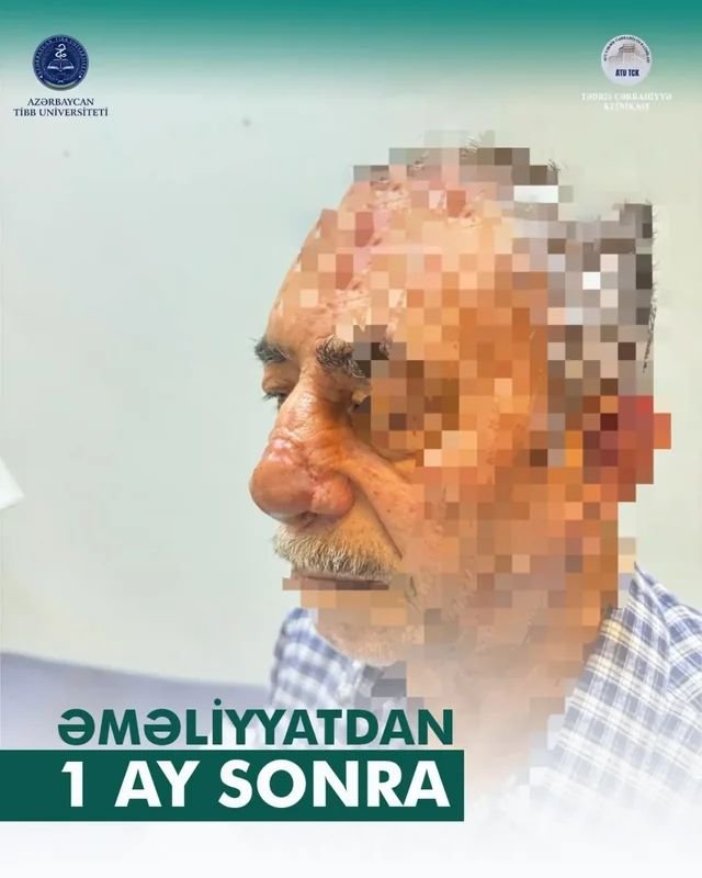 İt dişləməsi nəticəsində burnunu itirən xəstəyə yeni burun formalaşdırıldı - Azərbaycanda unikal əməliyyat – FOTO/VİDEO - foto 4