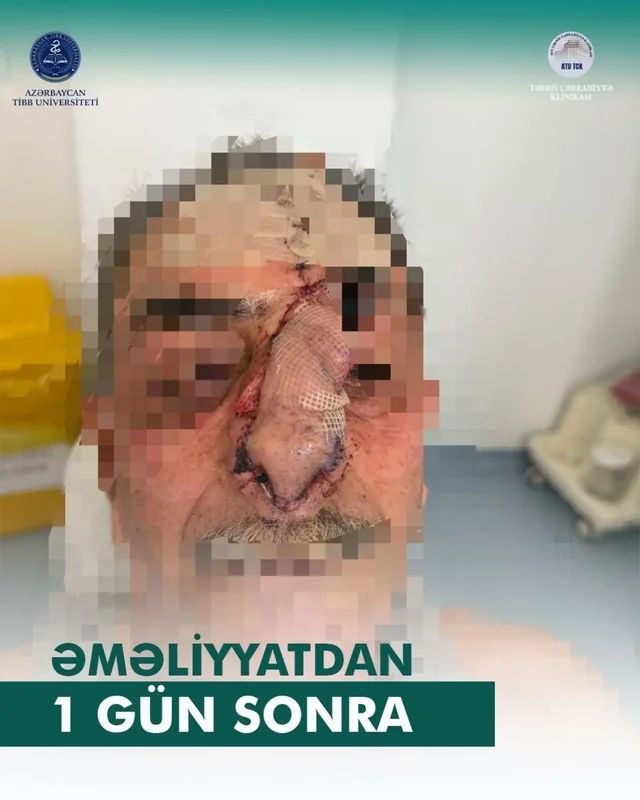 İt dişləməsi nəticəsində burnunu itirən xəstəyə yeni burun formalaşdırıldı - Azərbaycanda unikal əməliyyat – FOTO/VİDEO - foto 2