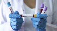 Azərbaycanda koronavirus: 988 yeni yoluxma, 11 ölüm