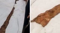 Şirvan sakininin qarnından tampon çıxarıldı - 8 ay əvvəl unudulub - FOTO - VİDEO