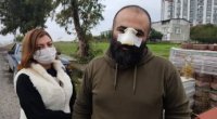 Türkiyədə azərbaycanlı iş adamının burnunu it dişlədi - FOTO