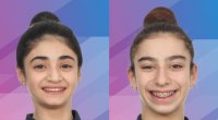 Gimnastlarımız Almaniyada 2 medal qazandılar