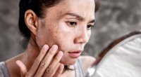 Dermatoloqdan xəbərdarlıq: Günəş yanığına qarşı bu addımları atın