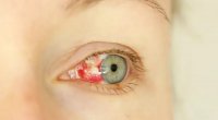 Göz qanaması ilə başlayan gizli virus yayılır
