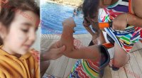 Lənkəranda qandonduran HADİSƏ – Ana isti qaşıqla 3 yaşlı qızının qolunu DAĞLADI – FOTO/VİDEO