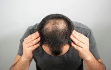 Kişilərdə saç tökülməsinə SON: Yeni vasitə hazırlandı
