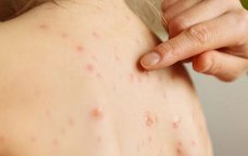 Uşaqlar arasında suçiçəyi yayılıb? &ndash; RƏSMİ AÇIQLAMA