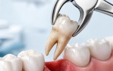 Stomatologiyanın &ldquo;səhnə arxası&rdquo; &ndash; Çəkilən çürük dişlər hara gedir?