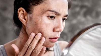 Dermatoloqdan xəbərdarlıq: Günəş yanığına qarşı bu addımları atın