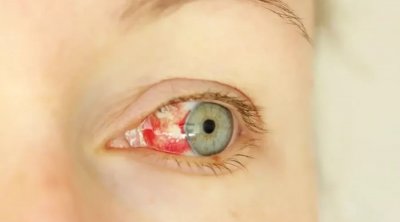 Göz qanaması ilə başlayan gizli virus yayılır