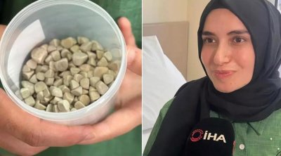 21 yaşlı Fatmanın bədənindən 287 daş çıxarıldı – FOTO