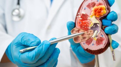 Böyrək daşlarının yaranmasına səbəb olan qidalar açıqlandı