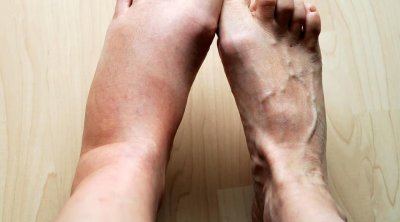 Ödemin gözlənilməz səbəbi AŞKARLANDI: Hansı qidalar şişkinliyi artırır?