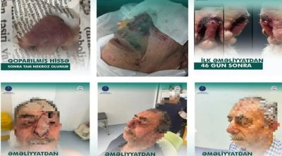 İt dişləməsi nəticəsində burnunu itirən xəstəyə yeni burun formalaşdırıldı - Azərbaycanda unikal əməliyyat – FOTO/VİDEO