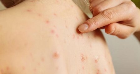 Uşaqlar arasında suçiçəyi yayılıb? &ndash; RƏSMİ AÇIQLAMA