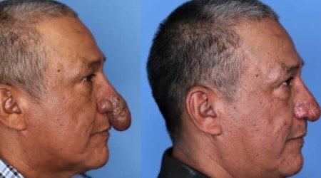 Burnu ağzına girdiyinə görə əməliyyat olundu - FOTO